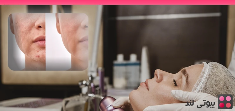 مقایسه جامع بین مزوتراپی و میکرونیدلینگ