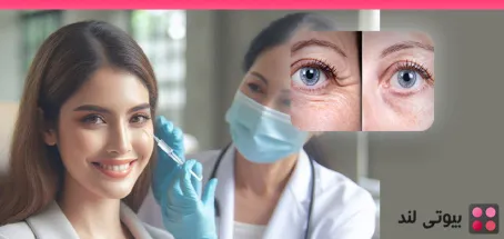 بوتاکس دور چشم : رفع خطوط و سیاهی زیر چشم