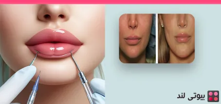 همه چیز درباره جراحی لیفت لب