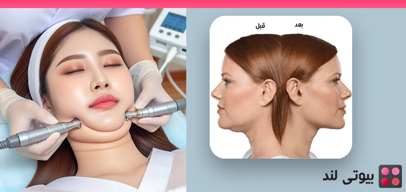 هایفوتراپی غبغب چیست؟ رفع غبغب بدون جراحی