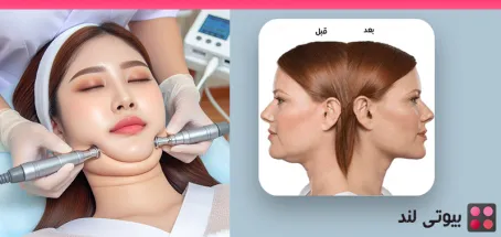 هایفوتراپی غبغب چیست؟ رفع غبغب بدون جراحی