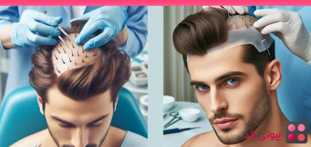 راهنمای کامل بهبود بعد از کاشت مو