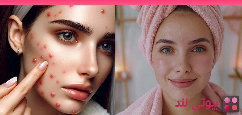 7 روش موثر برای درمان جای جوش و آکنه