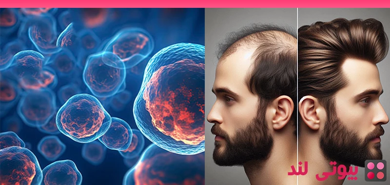 کاشت مو با سلول های بنیادی یا کاشت موی سنتی؟