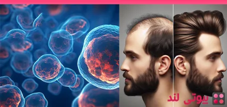 کاشت مو با سلول های بنیادی یا کاشت موی سنتی؟