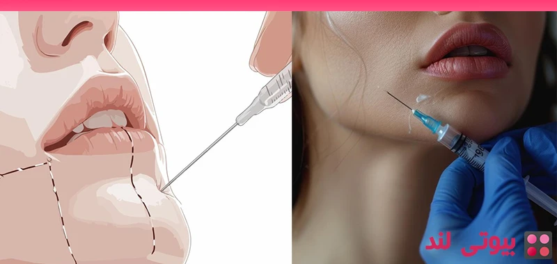 اصلاح عقب‌ رفتگی چانه با فیلر های پوستی