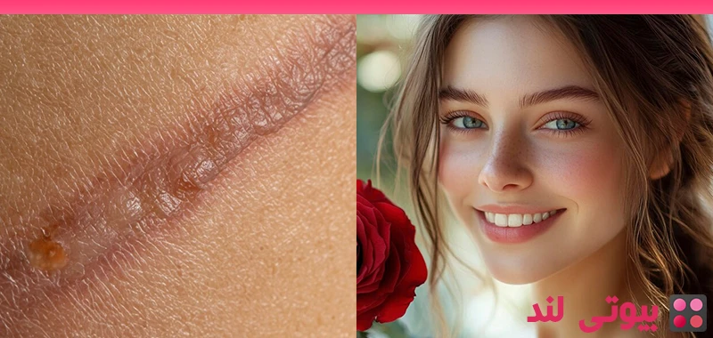 چگونه لیزر به کاهش زخم‌ها کمک می‌ کند؟ انواع روش ها