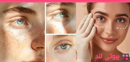 آیا بلفاروپلاستی می تواند باعث خشکی چشم شود؟
