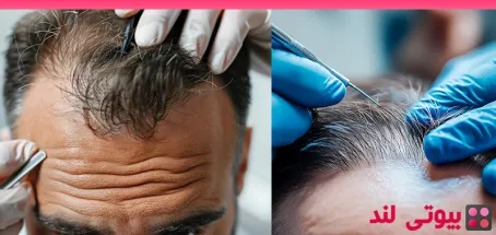 ۶ تصور غلط رایج درباره کاشت مو
