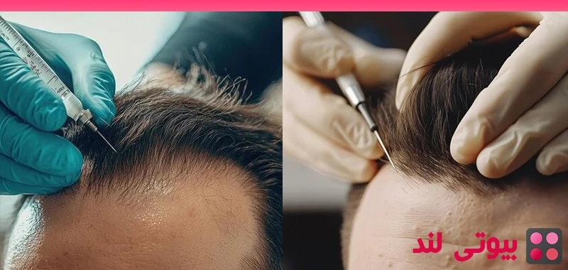 آیا ایجاد تاول پس از کاشت مو طبیعی است؟