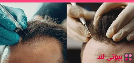 آیا ایجاد تاول پس از کاشت مو طبیعی است؟