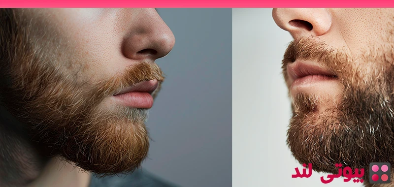 مراقبت‌ های پس از کاشت ریش | نکات ضروری